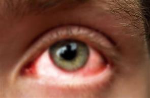 आई फ्लू के मरीजों की तादाद प्रतिदिन जिले में बढ़ रही, बच्चों से लेकर बुजुर्ग तक आ रहे संक्रमण की चपेट में, आईफ्लू से बचाव सावधानी से ही संभव